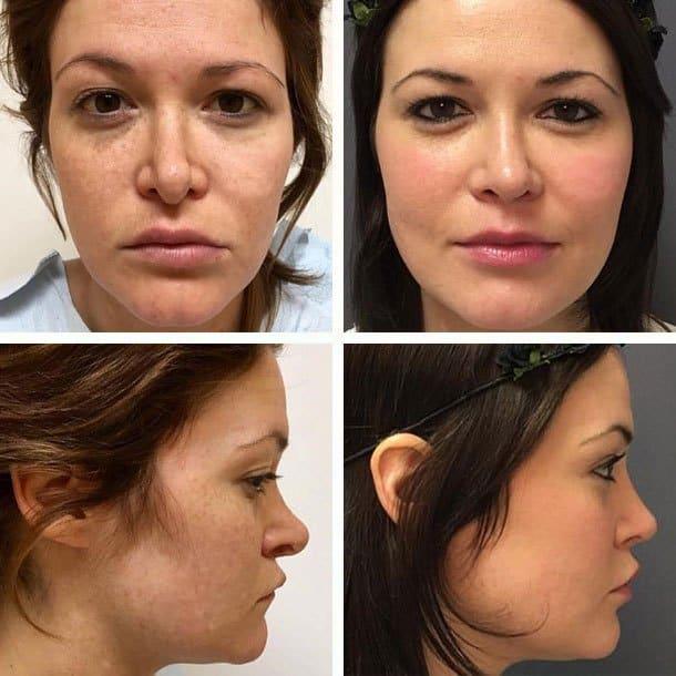 Rhinoplasty result at Ary Krau, MD in Miami, FL