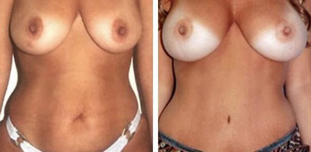Ary Krau, MD tummy tuck result — Miami, FL