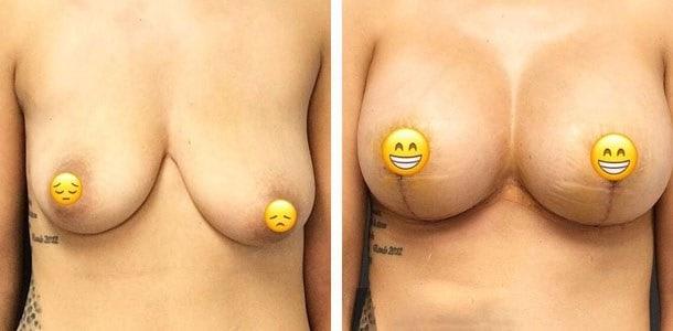 Breast Augmentation result at Ary Krau, MD in Bay Harbor Islands, FL