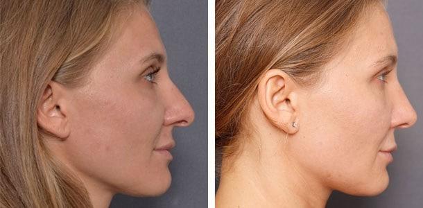 Rhinoplasty result at Ary Krau, MD in Bay Harbor Islands, FL