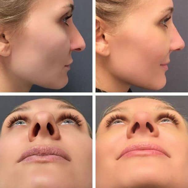 Rhinoplasty result at Ary Krau, MD in Bay Harbor Islands, FL