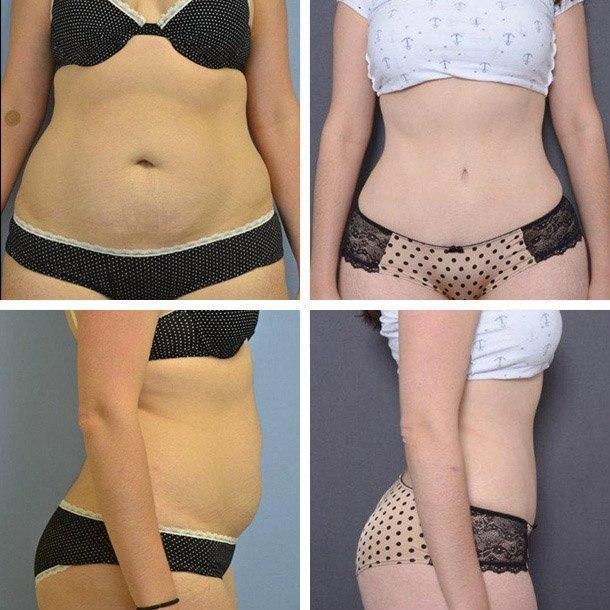Ary Krau, MD tummy tuck result — Miami, FL