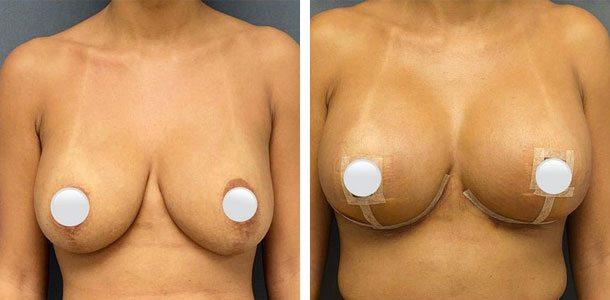 Breast Augmentation result at Ary Krau, MD in Bay Harbor Islands, FL