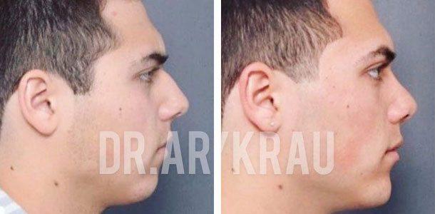 Rhinoplasty result at Ary Krau, MD in Bay Harbor Islands, FL