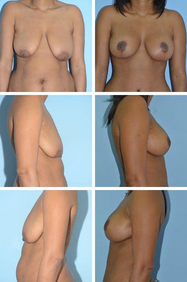 Breast Lift result at Ary Krau, MD in Miami, FL