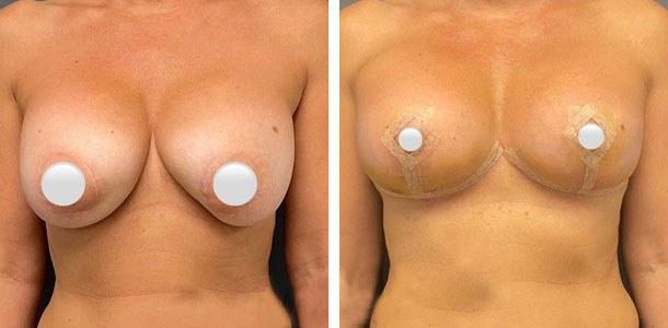 Breast Reduction result at Ary Krau, MD in Bay Harbor Islands, FL