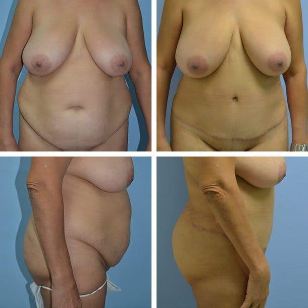 Ary Krau, MD tummy tuck result — Miami, FL