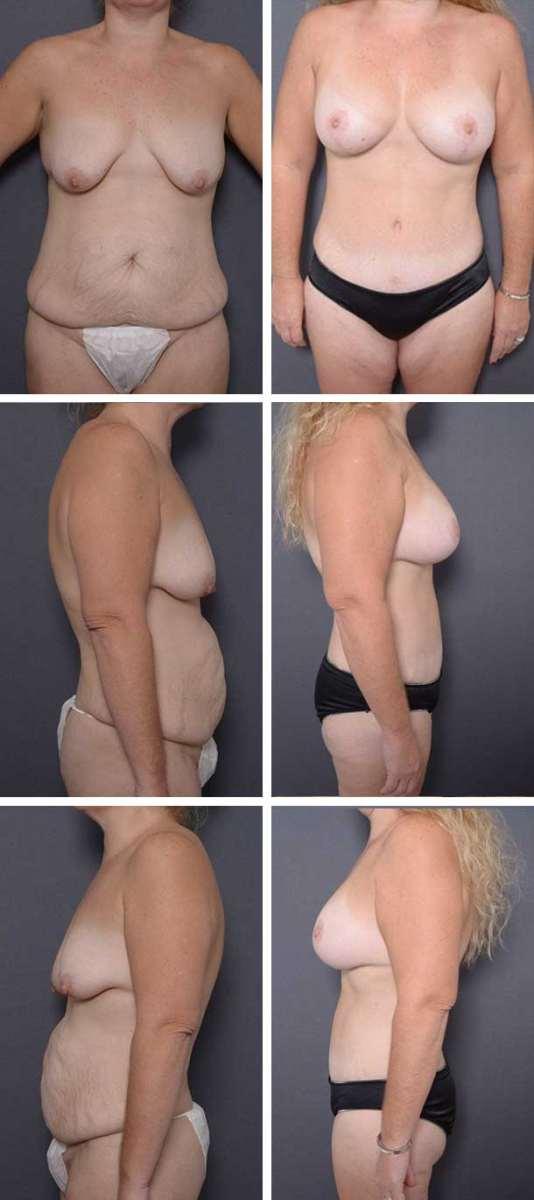 Ary Krau, MD mommy makeover result — Miami, FL