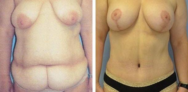 Ary Krau, MD mommy makeover result — Miami, FL