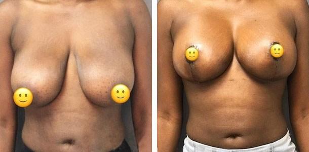 Breast Augmentation result at Ary Krau, MD in Bay Harbor Islands, FL