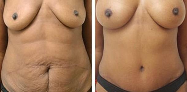 Ary Krau, MD mommy makeover result — Miami, FL