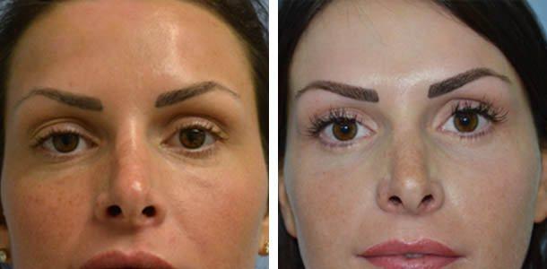 Blepharoplasty result at Ary Krau, MD in Bay Harbor Islands, FL