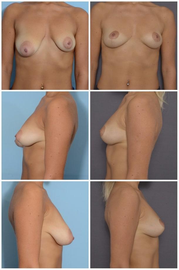 Breast Lift result at Ary Krau, MD in Bay Harbor Islands, FL