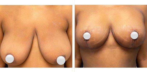 Breast Lift result at Ary Krau, MD in Bay Harbor Islands, FL