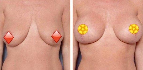 Breast Augmentation result at Ary Krau, MD in Bay Harbor Islands, FL