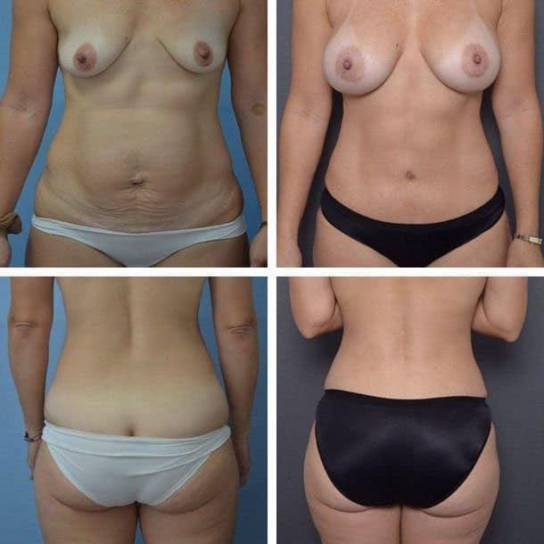 Mommy Makeover result at Ary Krau, MD in Bay Harbor Islands, FL