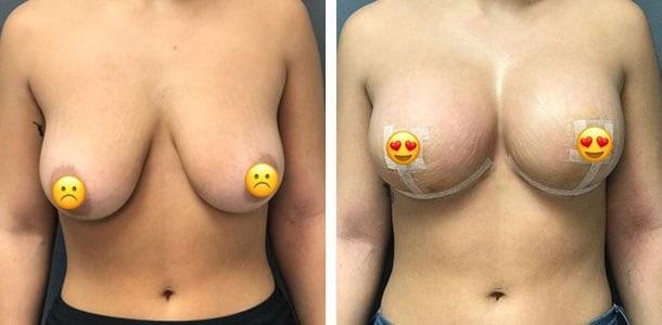 Breast Augmentation result at Ary Krau, MD in Bay Harbor Islands, FL