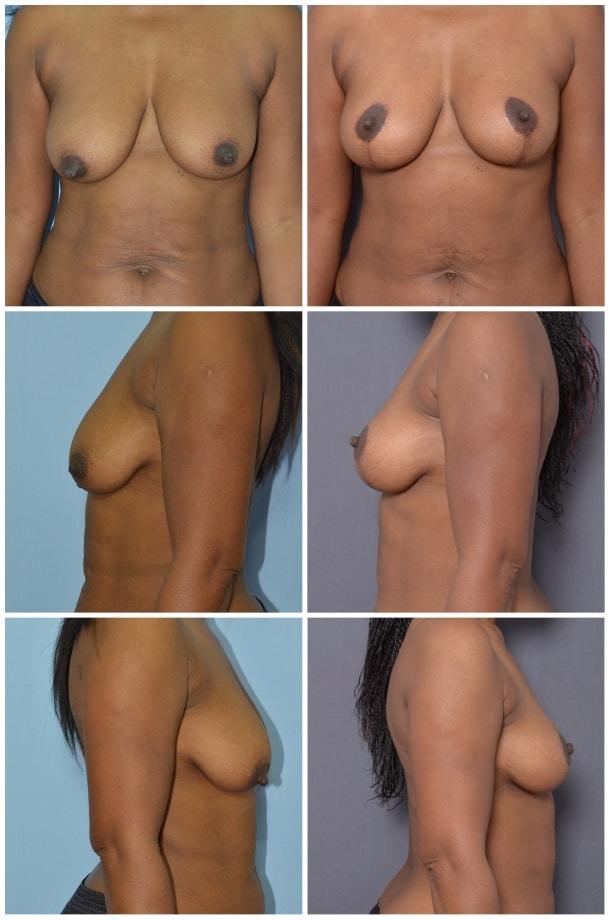 Breast Lift result at Ary Krau, MD in Bay Harbor Islands, FL