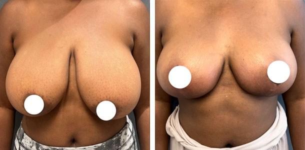 Breast Reduction result at Ary Krau, MD in Bay Harbor Islands, FL