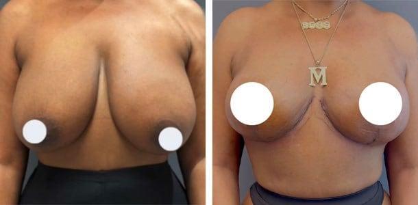Breast Reduction result at Ary Krau, MD in Bay Harbor Islands, FL