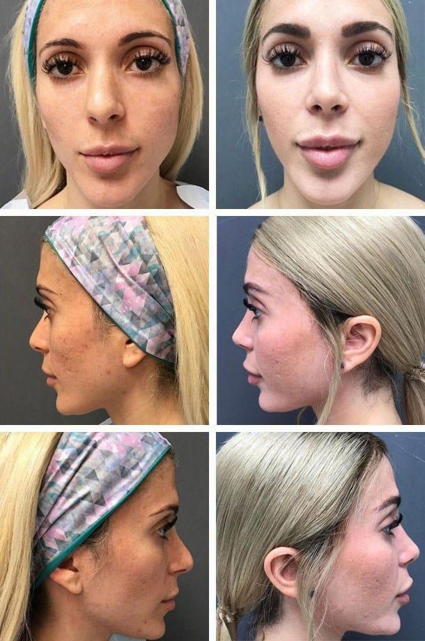 Rhinoplasty result at Ary Krau, MD in Bay Harbor Islands, FL