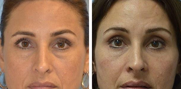 Blepharoplasty result at Ary Krau, MD in Bay Harbor Islands, FL