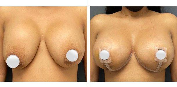 Breast Lift result at Ary Krau, MD in Bay Harbor Islands, FL
