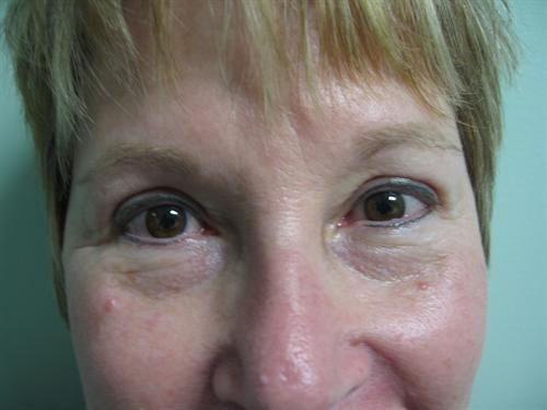 Y Plastic Surgery (Asaf Yalif, MD) eyelid lift after — Alpharetta, GA
