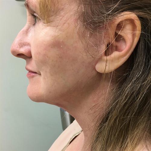 Y Plastic Surgery (Asaf Yalif, MD) neck lift after — Alpharetta, GA