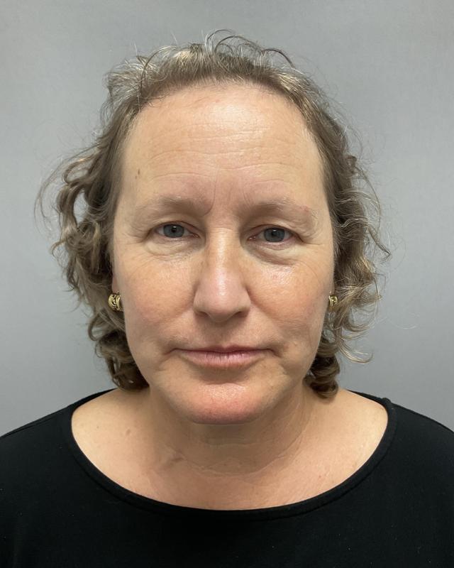 Neck Lift before at Y Plastic Surgery (Asaf Yalif, MD) in Alpharetta, GA