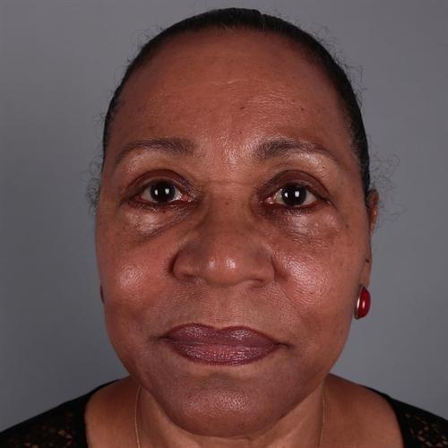 Deep Plane Facelift after at Y Plastic Surgery (Asaf Yalif, MD) in Alpharetta, GA