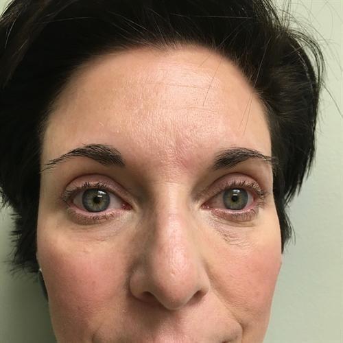 Y Plastic Surgery (Asaf Yalif, MD) eyelid lift after — Alpharetta, GA