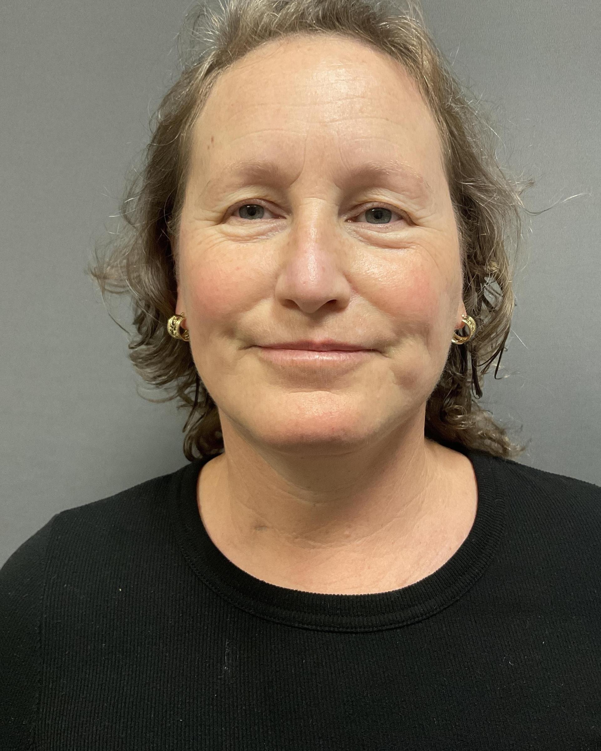 Y Plastic Surgery (Asaf Yalif, MD) facelift after — Alpharetta, GA