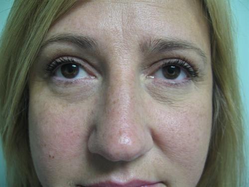 Y Plastic Surgery (Asaf Yalif, MD) eyelid lift after — Alpharetta, GA