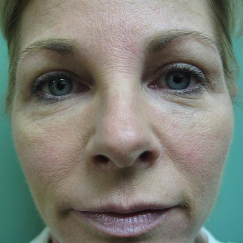 Y Plastic Surgery (Asaf Yalif, MD) eyelid lift after — Alpharetta, GA
