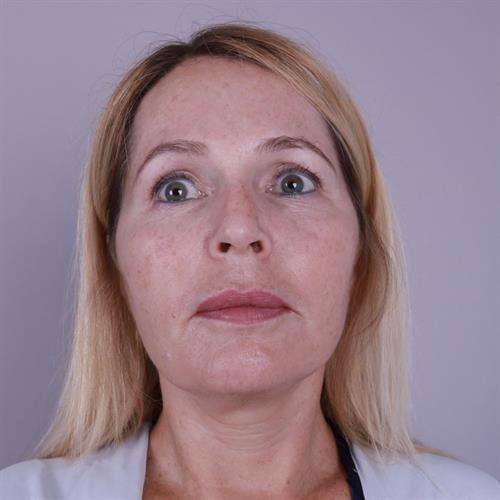 Y Plastic Surgery (Asaf Yalif, MD) neck lift after — Alpharetta, GA