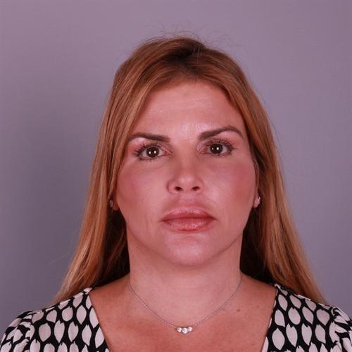 Y Plastic Surgery (Asaf Yalif, MD) neck lift after — Alpharetta, GA
