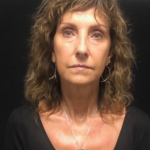 Y Plastic Surgery (Asaf Yalif, MD) neck lift after — Alpharetta, GA