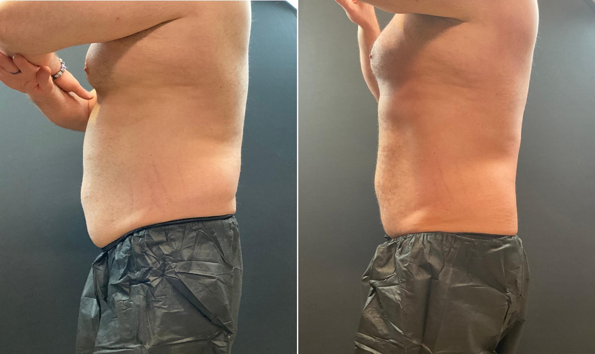 AOB Med Spa fat freezing result — Greenwood Village, CO