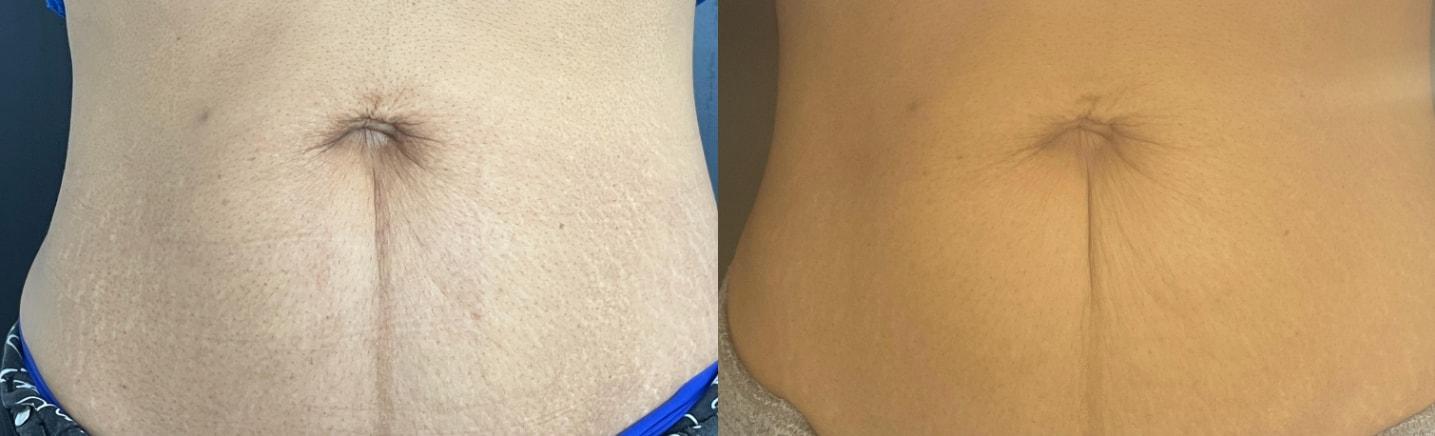 AOB Med Spa morpheus8 result — Greenwood Village, CO