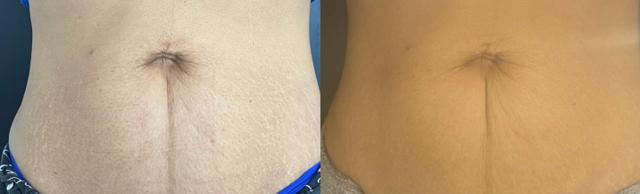 Morpheus8 result at AOB Med Spa in Greenwood Village, CO