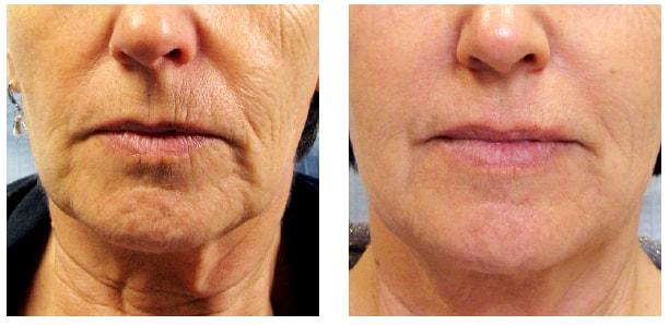 AOB Med Spa skin tightening result — Greenwood Village, CO