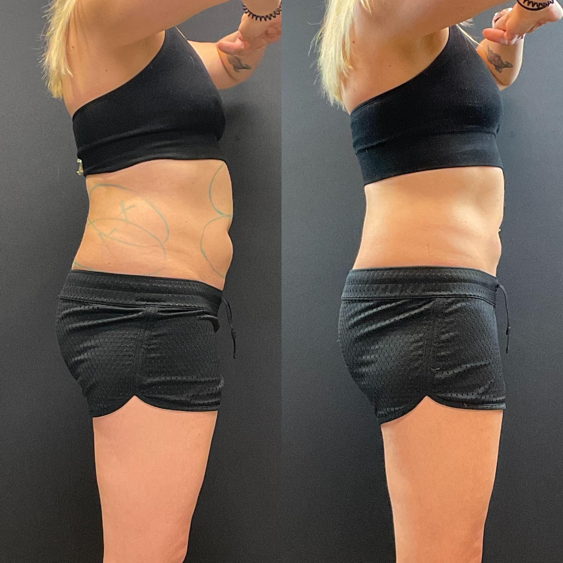 AOB Med Spa fat freezing result — Greenwood Village, CO