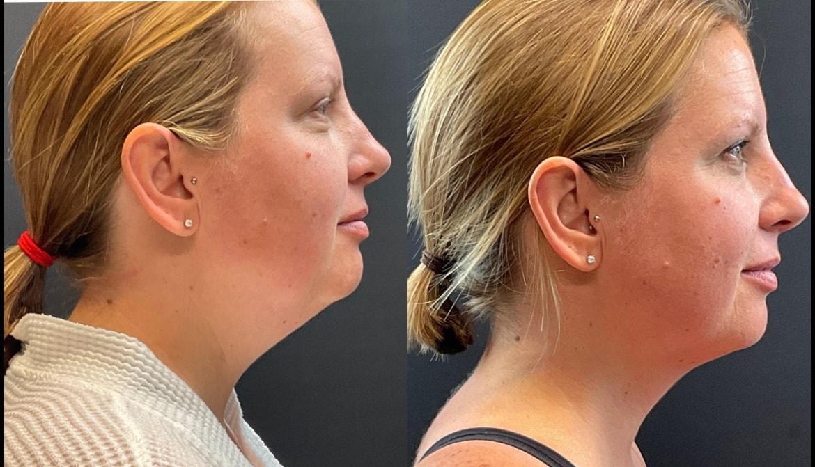 AOB Med Spa fat freezing result — Greenwood Village, CO