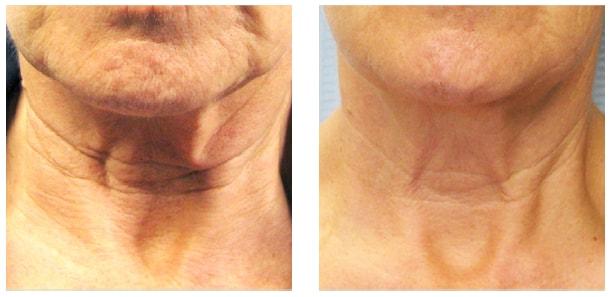 AOB Med Spa skin tightening result — Greenwood Village, CO