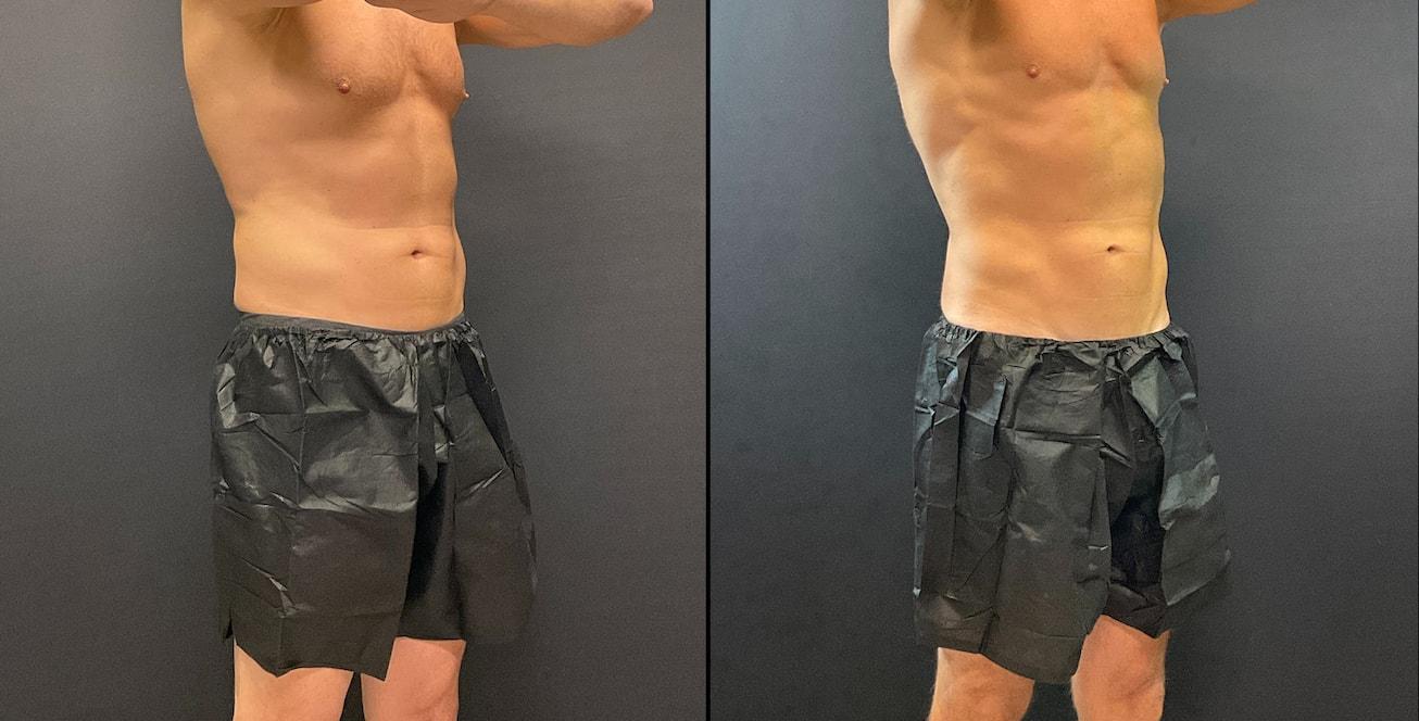 AOB Med Spa fat freezing result — Greenwood Village, CO