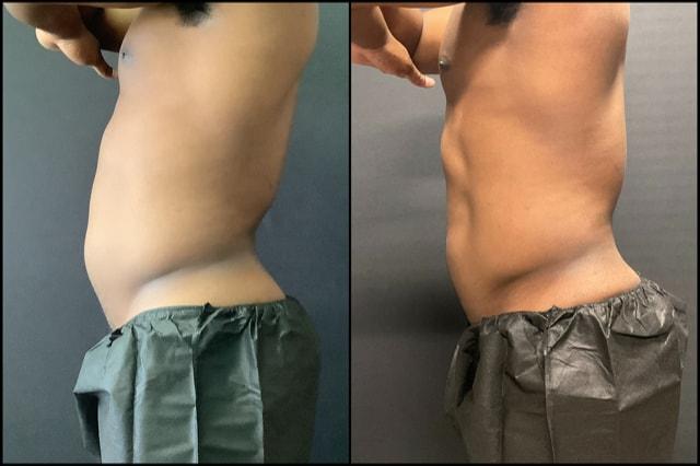 AOB Med Spa fat freezing result — Greenwood Village, CO