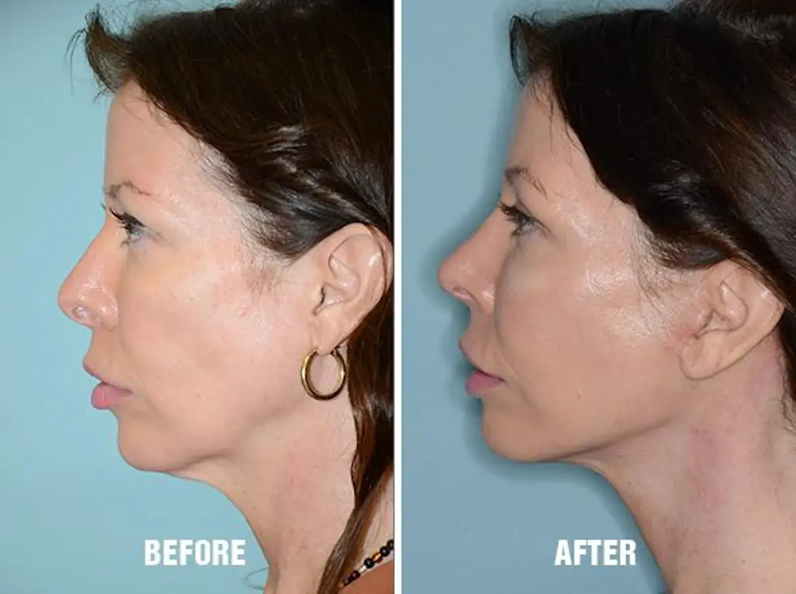 Dr. Anthony Bared Facial Plastic Surgery blepharoplasty result — Miami, FL
