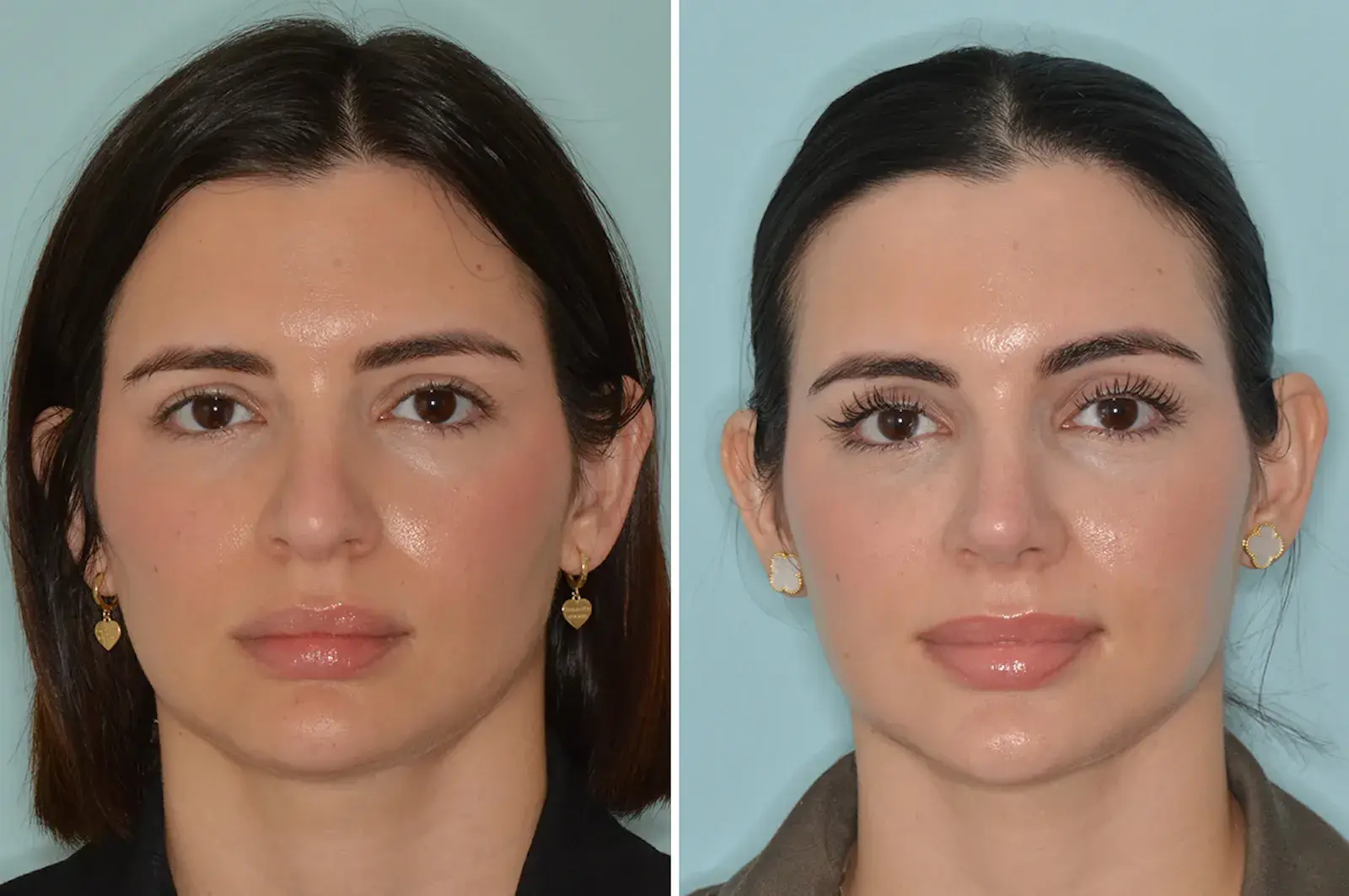 Dr. Anthony Bared Facial Plastic Surgery rhinoplasty result — Miami, FL