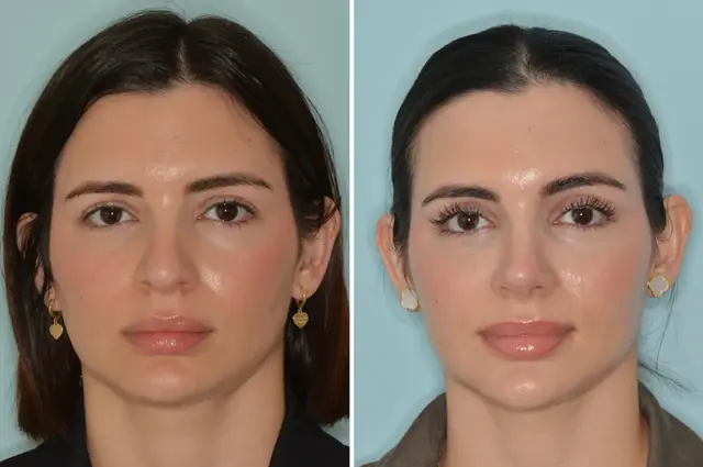 Functional Rhinoplasty result at Dr. Anthony Bared Facial Plastic Surgery in Miami, FL